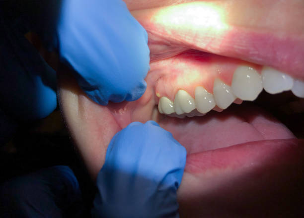 Best Emergency Denture Repair in Fishersville, VA